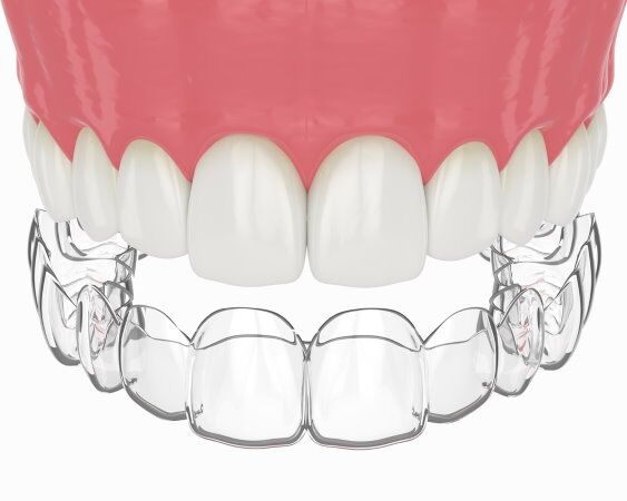 Invisalign in Flower Mound, TX