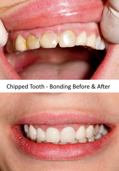 Repair Chipped Teeth With Bonding
