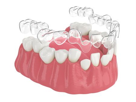 Cost of Braces Near Me in Dallas TX