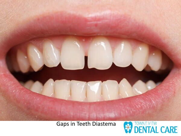 Diastema: What is Gaps Between Teeth? Causes, Treatment, Hereditary?